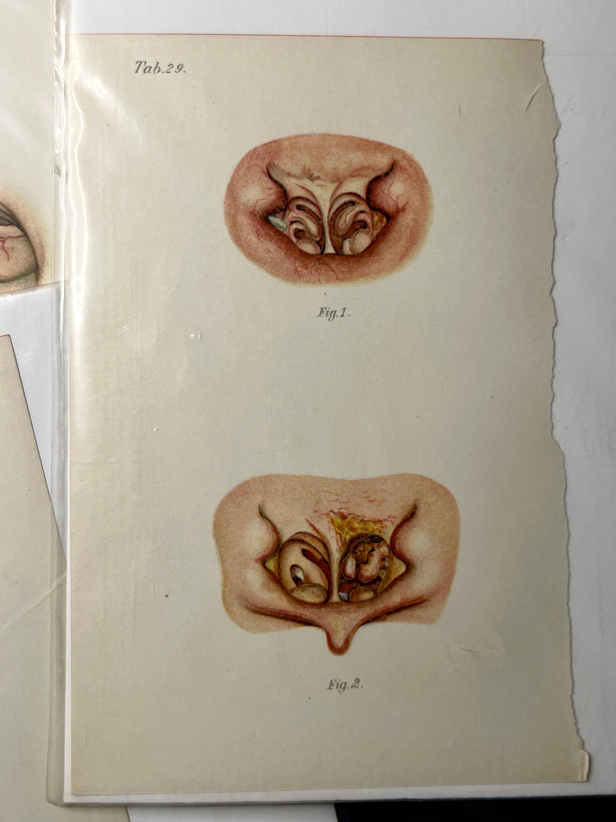 Vintage Oral Disease Medical Prints