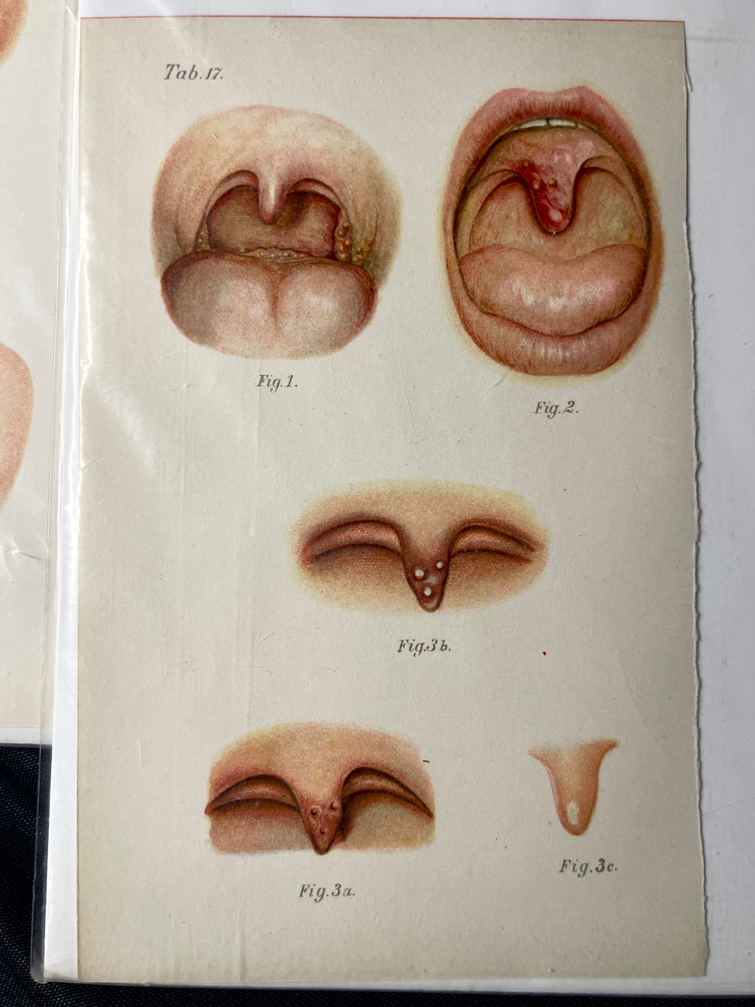 Vintage Oral Disease Medical Prints