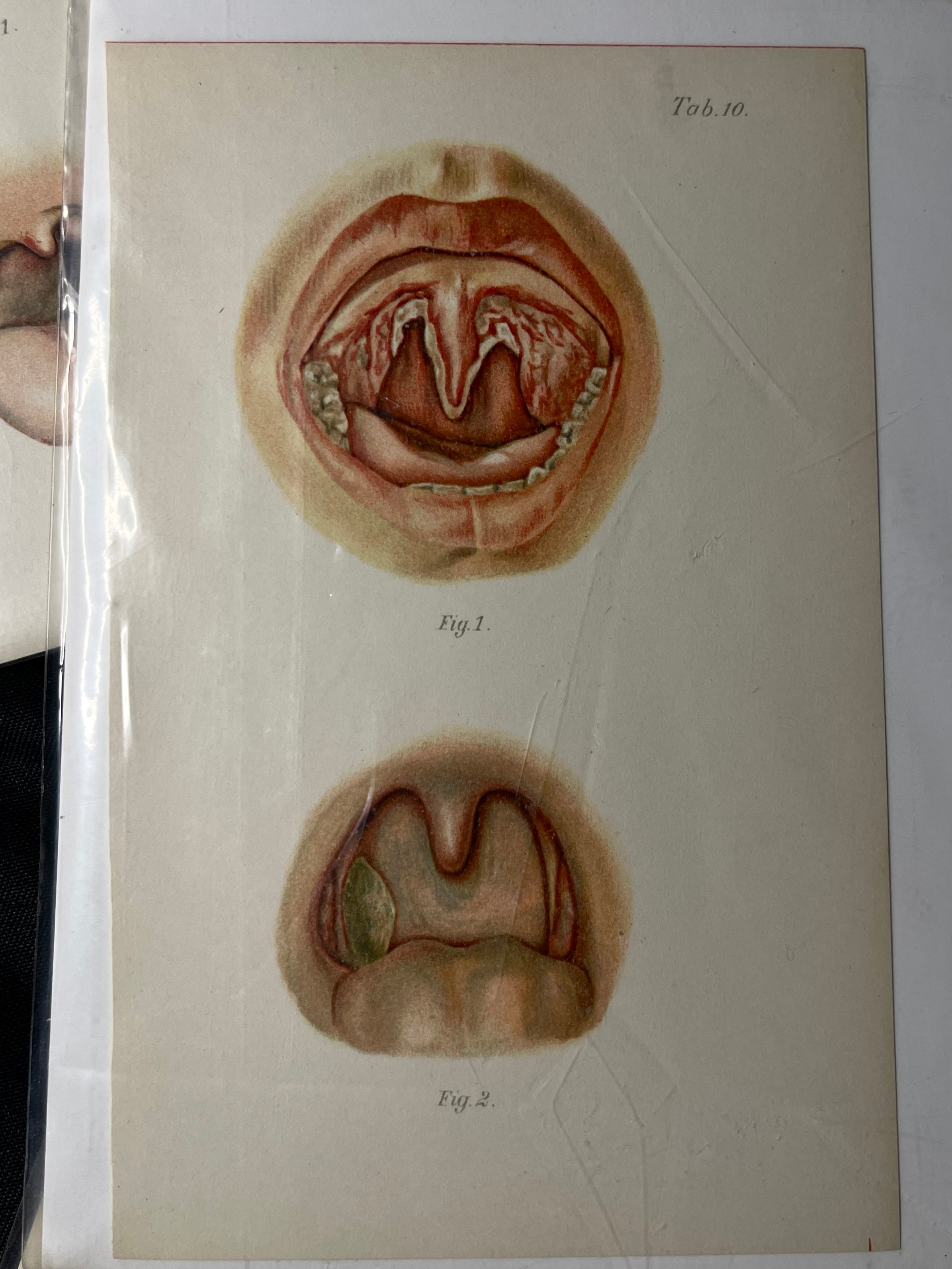 Vintage Oral Disease Medical Prints